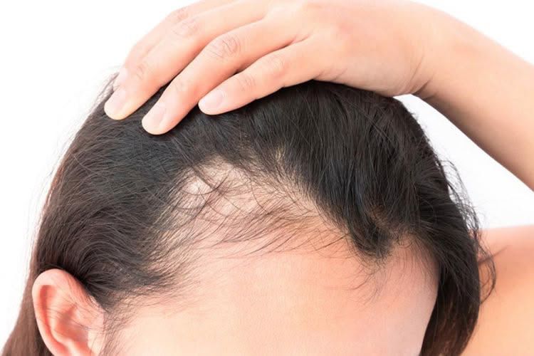 Queda de cabelo e doenças do couro cabeludo - Dra. Juliana Araújo, dermatologista em Barbacena
