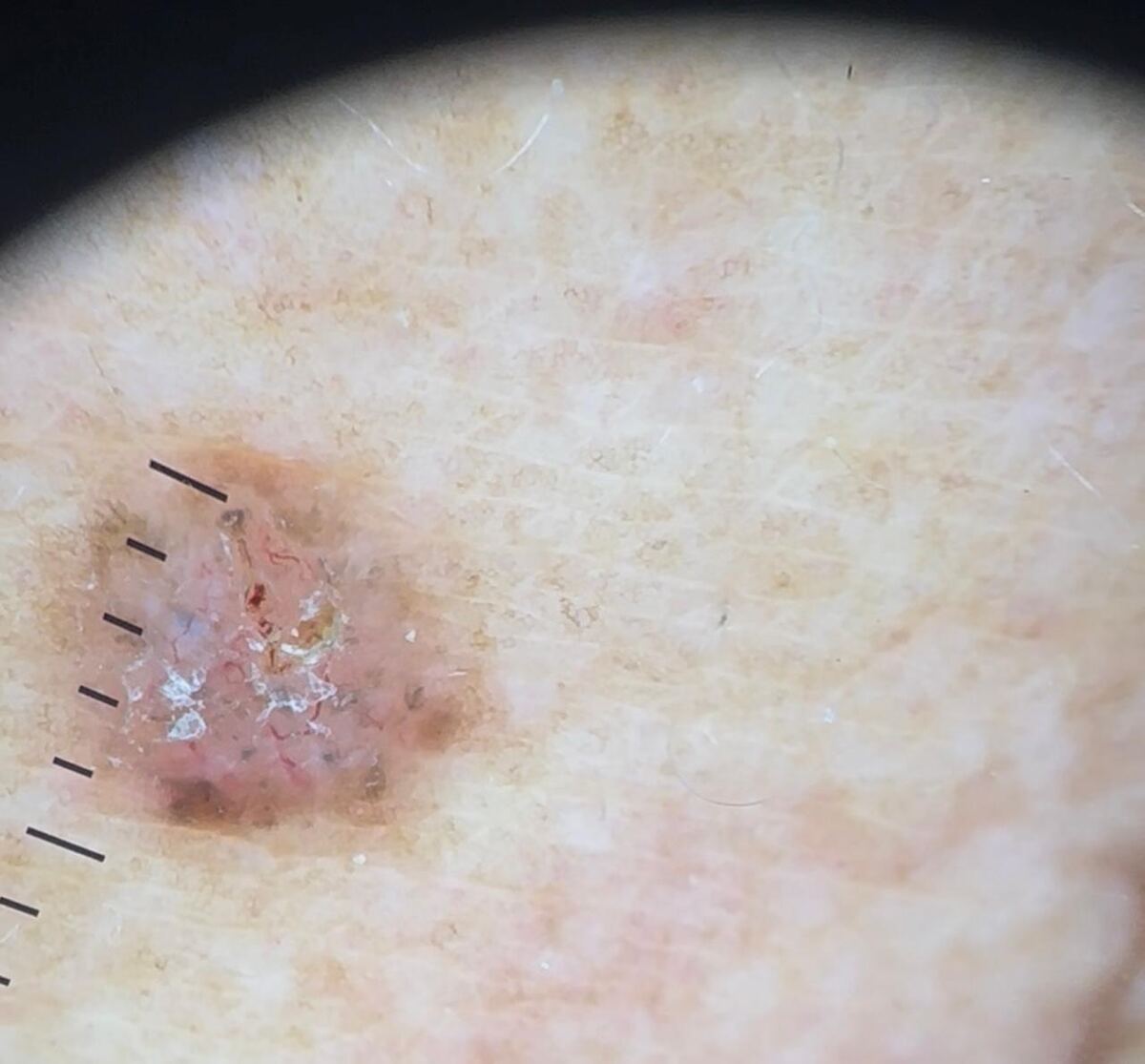 Manchas e câncer de pele - Dra. Juliana Araújo, dermatologista em Barbacena