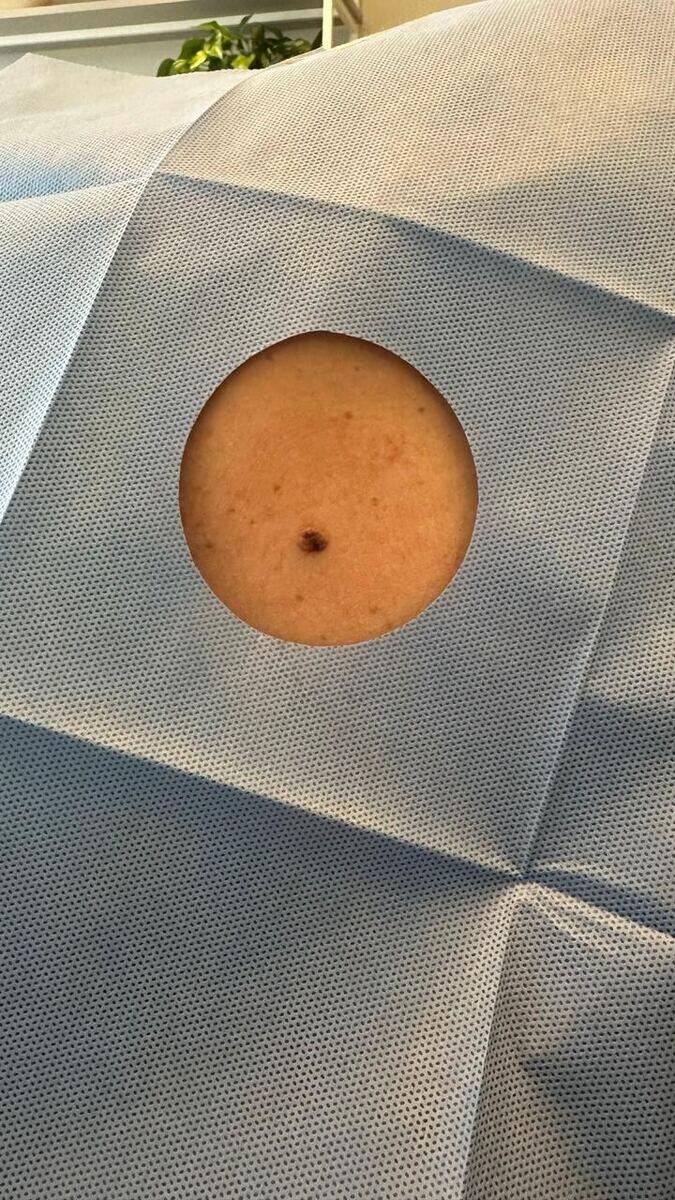 Outras cirurgias dermatológicas - Dra. Juliana Araújo, dermatologista em Barbacena